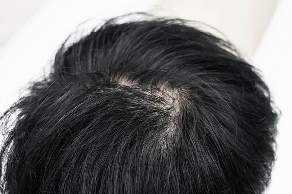 ●●シャンプー×育毛剤の２段階ケアの育毛法が生えすぎてガチですごい件…